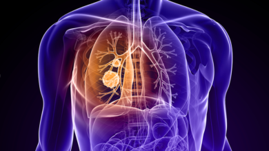 What You Need to Know About Lung Cancer Stages and Care Plans