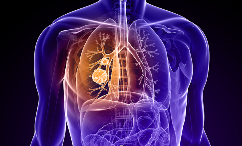 What You Need to Know About Lung Cancer Stages and Care Plans