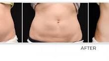 Tummy Tuck in Dubai