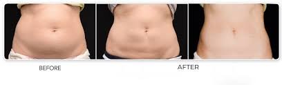 Tummy Tuck in Dubai
