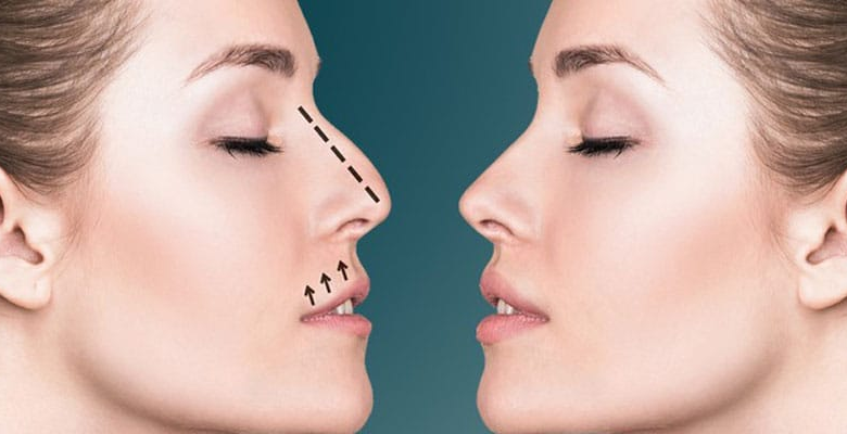 Why Rhinoplasty Is Becoming Popular Among Millennials
